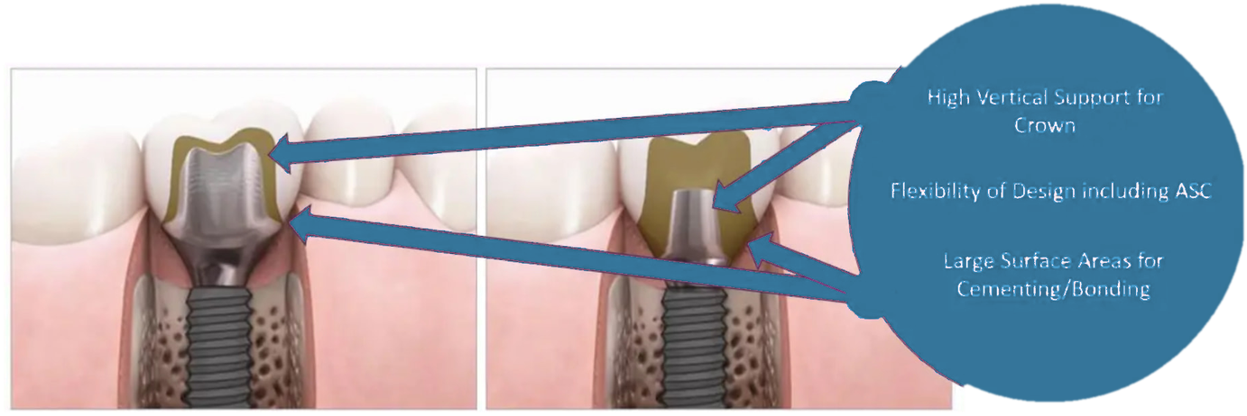 Cross-section comparison of two implant restorations, annotated with high vertical support for the crown, flexibility of design including ASC, and large surface areas for cementing or bonding
