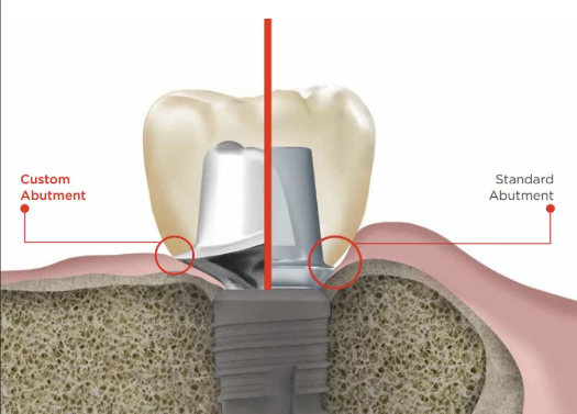Comparison showing a stock abutment with a gap versus a custom abutment with an optimal emergence profile